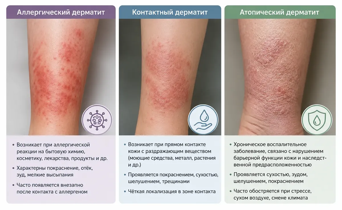 Аллергический, контактный и атопический дерматит на ногах разница